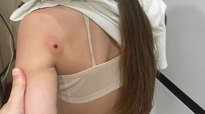 Фото: ррана после выстрела из воздушки, кадр ТГ Чё по Ростову