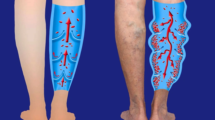 Фото: Заболевание вен