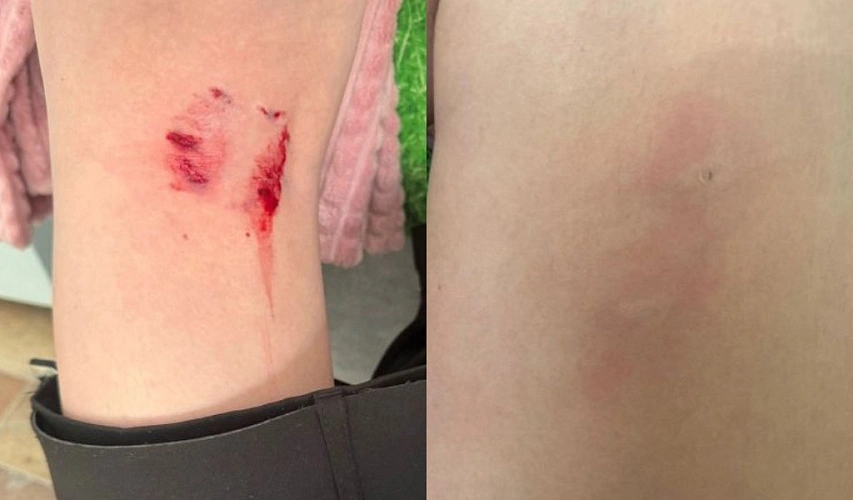 Фото: укусы бездомных собак // кадр Kvu.su