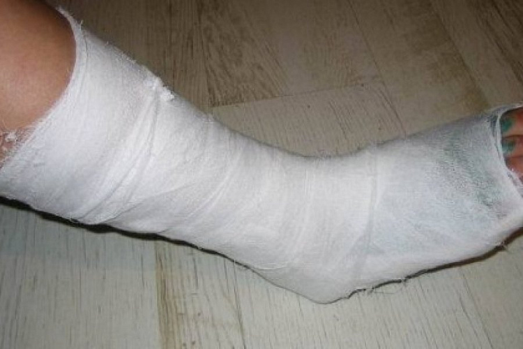Трещина гипс. Гипсование перелом малоберцовой кости. Гипс при переломе большого пальца ноги. Перелом большого пальца на ноге гипс.